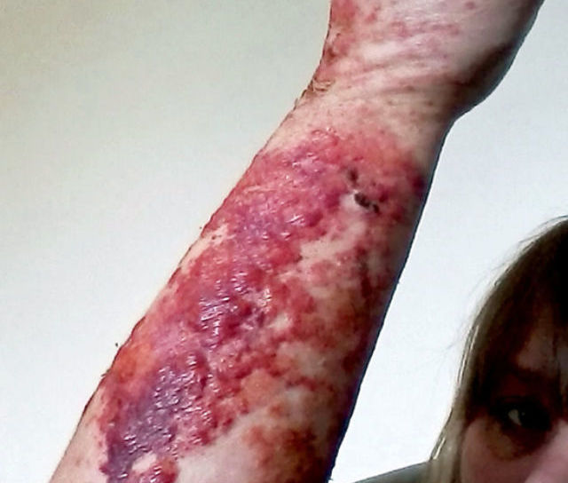 Giant Hogweed - What you Need to Know